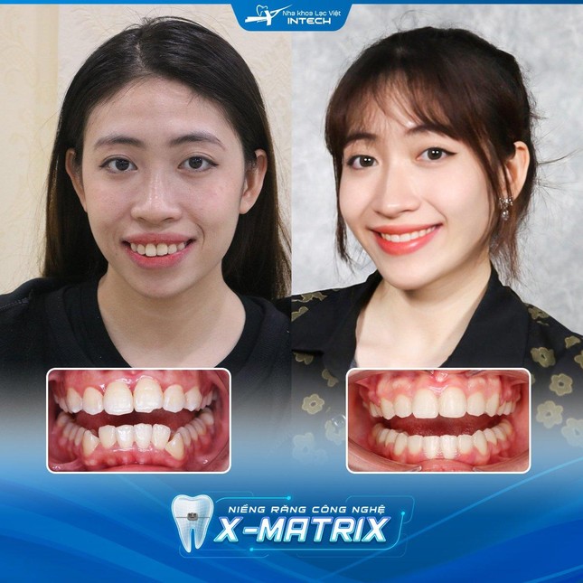 Giải pháp nào giúp giảm nguy cơ biến chứng niềng răng? ảnh 3
