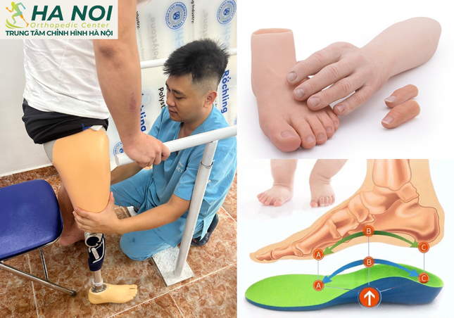 Trung tâm chỉnh hình Hà Nội: Niềm hy vọng cho những bệnh nhân khuyết tật ảnh 1