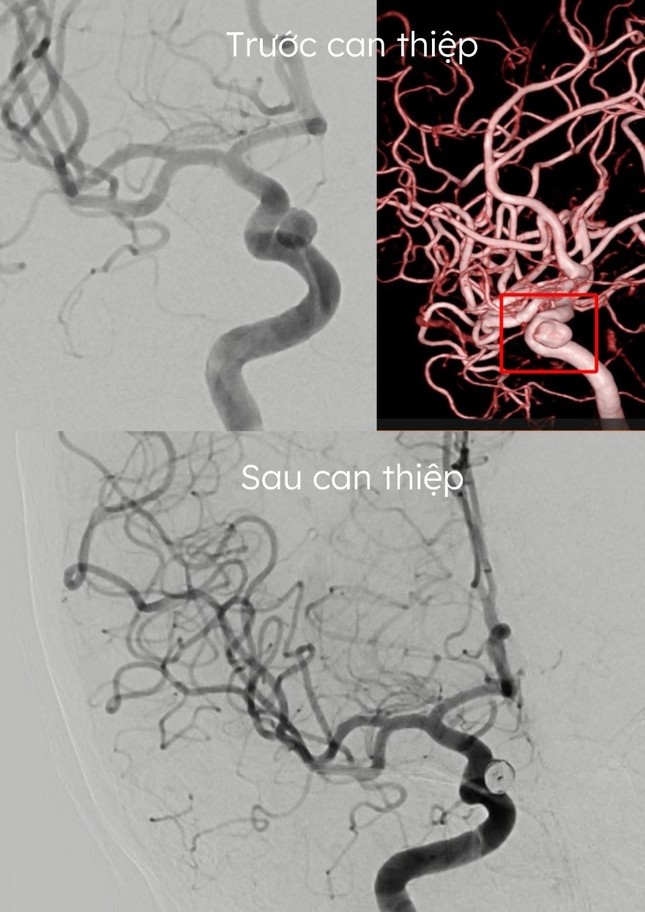 Tiết kiệm hơn 100 triệu đồng nhờ kỹ thuật đặt coil điều trị phình mạch não ảnh 2