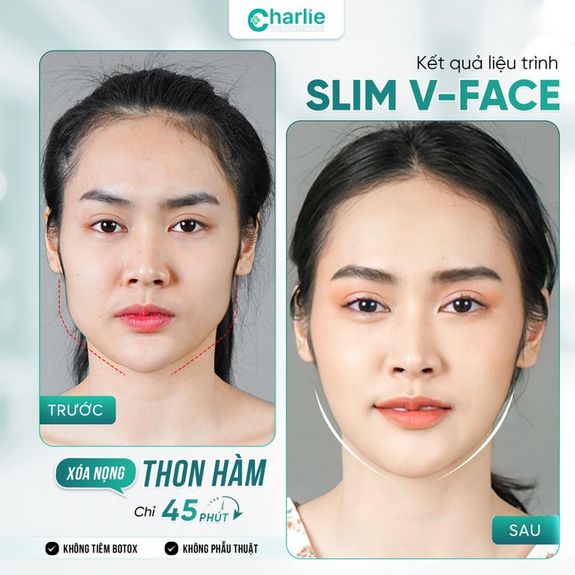 Phòng khám Charlie tạo bước đột phá với xu hướng thon gọn hàm không xâm lấn ảnh 4