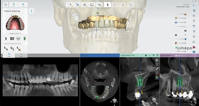 Bước đột phá mới trong việc giảm thiểu nguy cơ biến chứng trong cấy ghép implant đầu năm 2024 ảnh 2