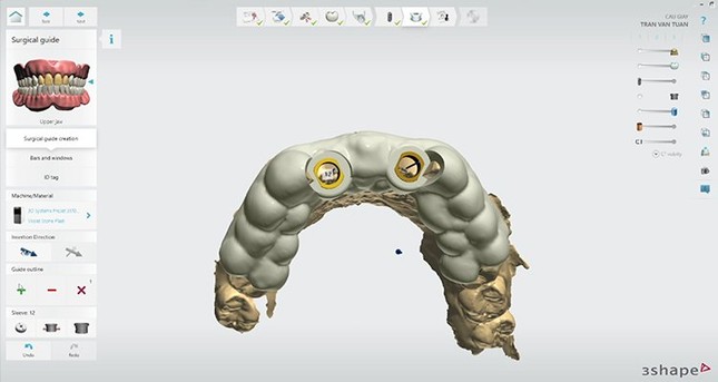 Bước đột phá mới trong việc giảm thiểu nguy cơ biến chứng trong cấy ghép implant đầu năm 2024 ảnh 3