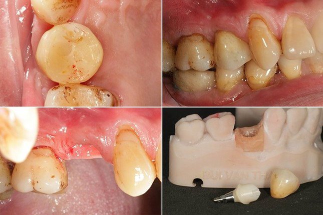 Bước đột phá mới trong việc giảm thiểu nguy cơ biến chứng trong cấy ghép implant đầu năm 2024 ảnh 4