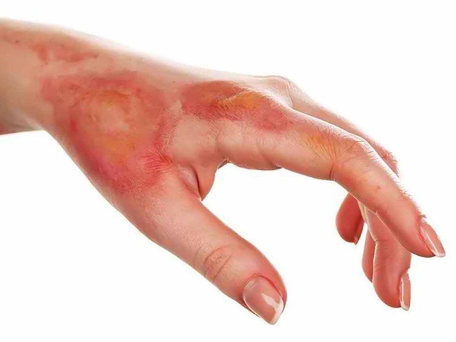Mờ sẹo không khó với Actiscar ảnh 2