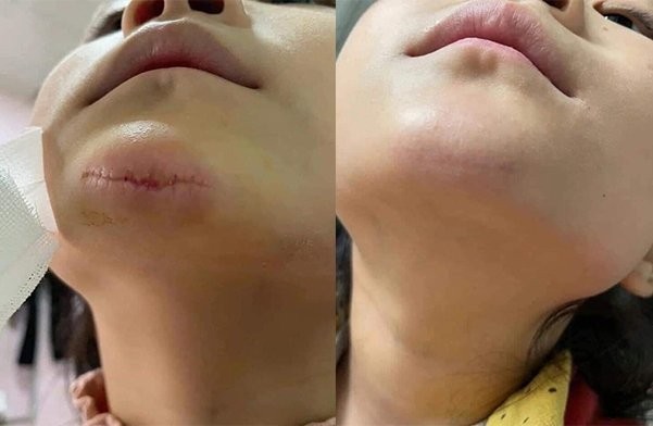 Mờ sẹo không khó với Actiscar ảnh 5