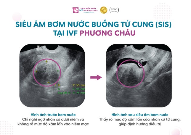 Kiểm tra tử cung – vòi trứng: Phương pháp hiệu quả và an toàn ảnh 1