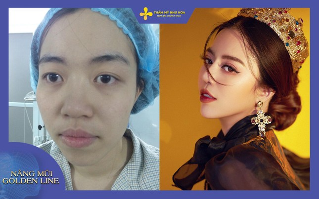 Trẻ lâu hơn với dịch vụ nâng mũi độc quyền ở Thẩm mỹ Như Hoa ảnh 2