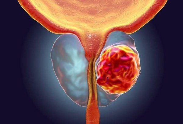 Nút mạch tiền liệt tuyến: Phương pháp điều trị phì đại không phẫu thuật ảnh 1