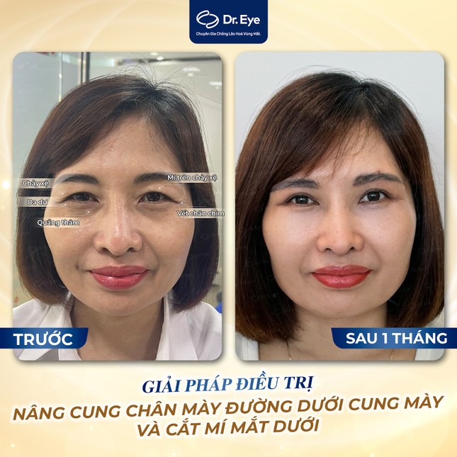 Dr. Eye - Địa chỉ nâng cung chân mày hàng đầu tại TP. HCM ảnh 2