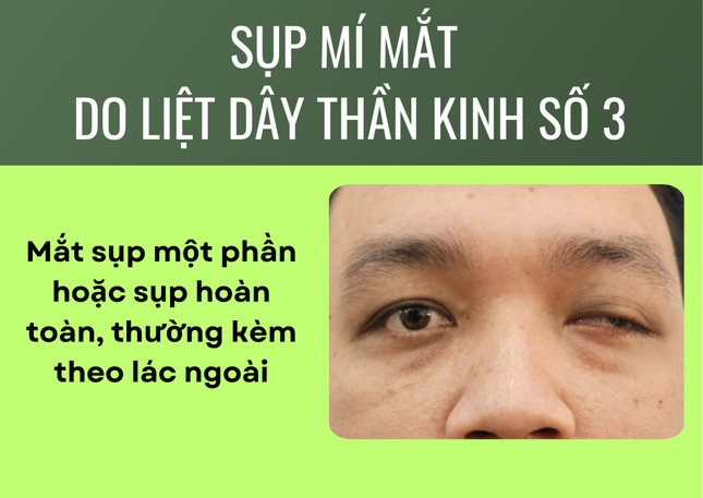 Tại sao liệt dây thần kinh số 3 gây sụp mí mắt? ảnh 2