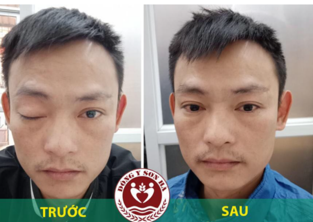 Tại sao liệt dây thần kinh số 3 gây sụp mí mắt? ảnh 3