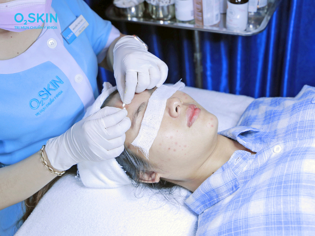 Cách trị mụn đầu đen hiệu quả: Những việc nên và không nên làm ảnh 2