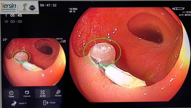 Những khả năng phi thường của A.I trong nội soi tiêu hóa ảnh 3