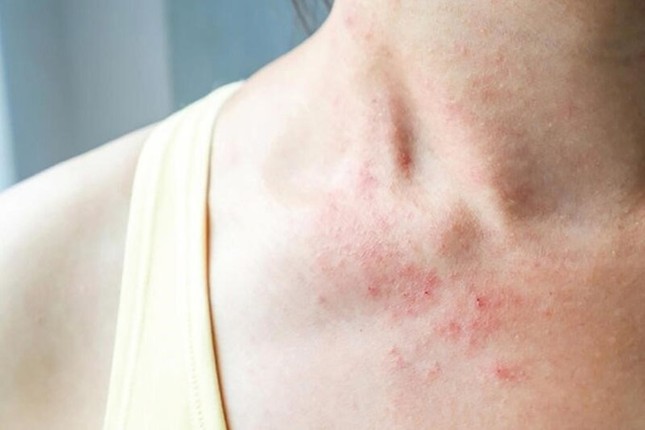 Bảo Thanh Đường - Địa chỉ uy tín chữa bệnh chàm (eczema) ảnh 1