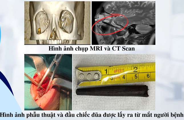 Chuyện khó tin: Đũa gỗ dài 6cm nằm trong mắt, người đàn ông không hề hay biết ảnh 1