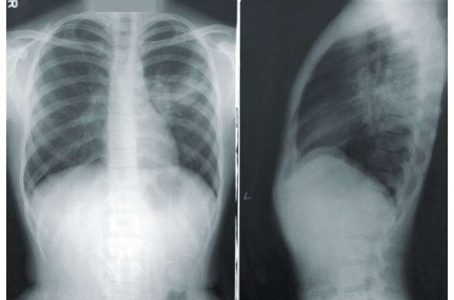 Tìm ra nguyên nhân vì sao nhiều người không bao giờ hút thuốc lá lại bị ung thư phổi ảnh 1
