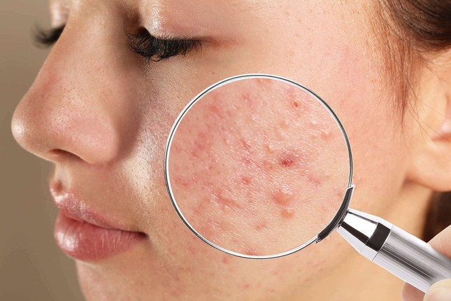 Skincare chăm chỉ nhưng da vẫn nổi mụn, nguyên nhân là do dưỡng ẩm quá đà ảnh 1