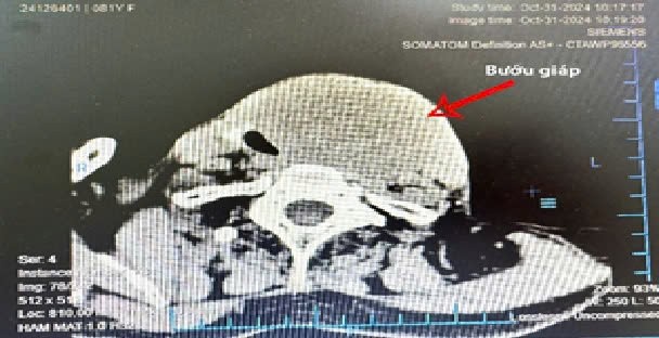 Bình Định: Phẫu thuật thành công khối bướu 'khủng' cho cụ bà 81 tuổi ảnh 1