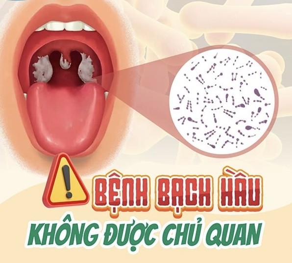 Bạch hầu là bệnh gì, vì sao có thể tử vong trong vài ngày?