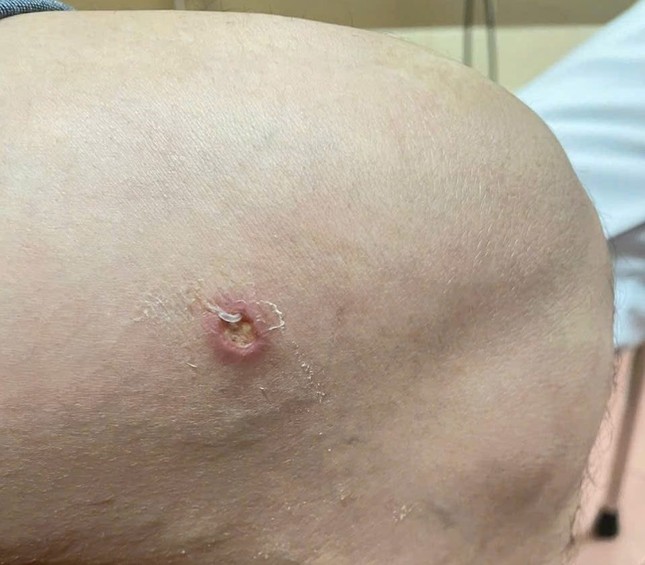 Phú Thọ tiếp tục phát hiện người nhiễm giun rồng ảnh 2
