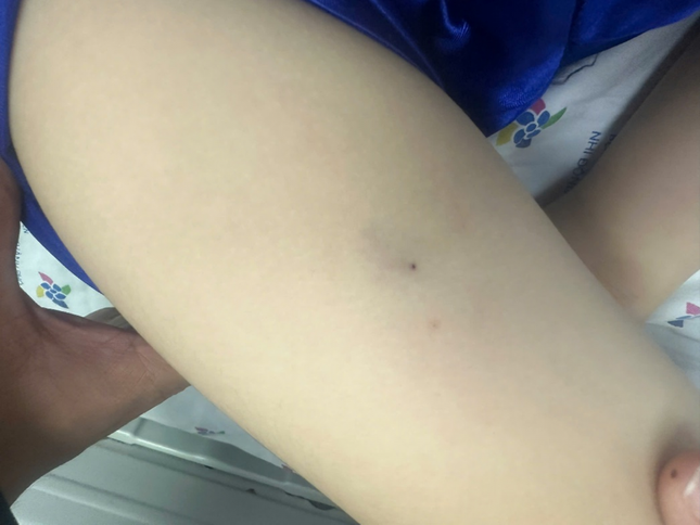 Bé trai sốc phản vệ nguy kịch vì vết đốt của ong ruồi ảnh 1