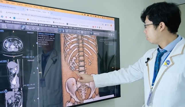 Sỏi san hô &apos;ăn&apos; hết thận bệnh nhân ảnh 1