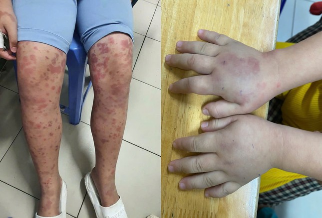 Cảnh báo biến chứng suy thận suốt đời từ viêm mạch máu ở trẻ ảnh 1