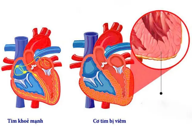Bị chẩn đoán nhầm viêm dạ dày, bệnh nhân viêm cơ tim suýt tử vong ảnh 2