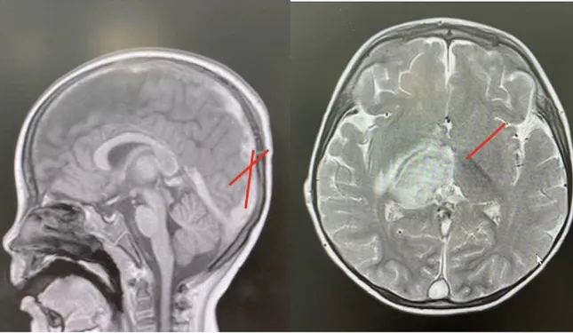 Bé trai hơn 2 tuổi đột quỵ vì bệnh lý hiếm gặp- Ảnh 1. Bé trai hơn 2 tuổi đột quỵ vì bệnh lý hiếm gặp- Ảnh 1.