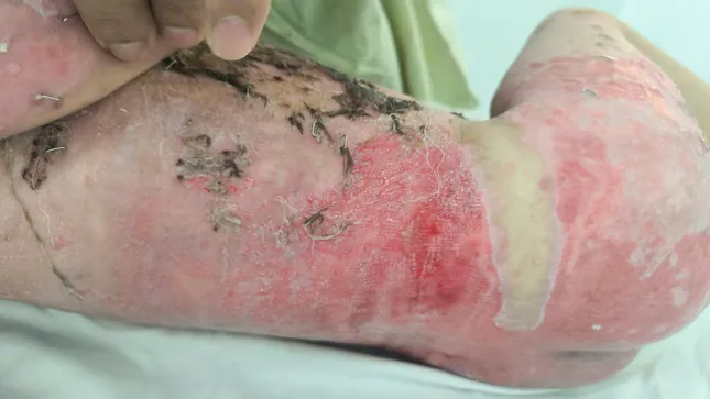 Mẹ lóc da cứu con bị bỏng nước sôi thoát chết ảnh 1