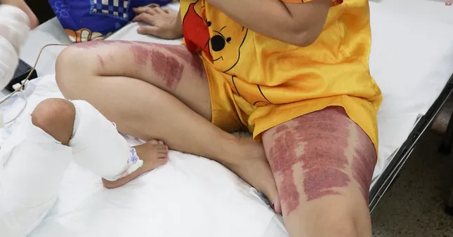 Mẹ lóc da cứu con bị bỏng nước sôi thoát chết ảnh 2