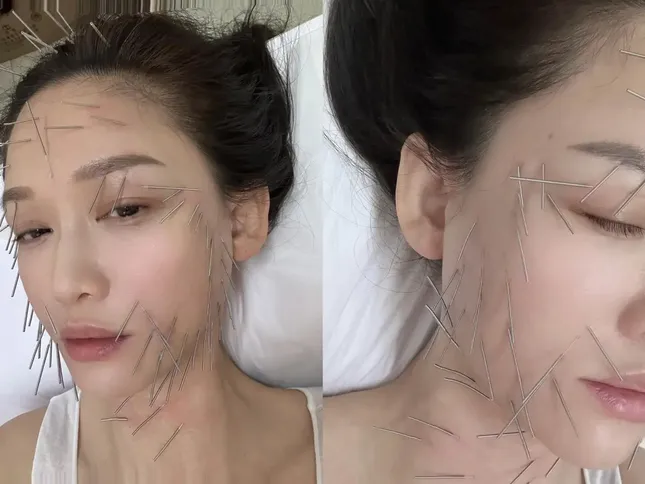 Trần Kiều Ân gây tranh cãi với phương pháp làm đẹp đau đớn ảnh 1