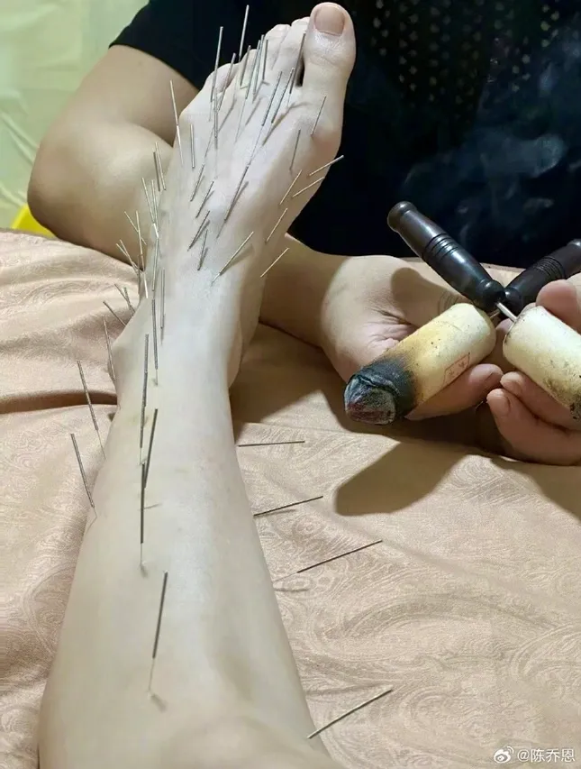 Trần Kiều Ân gây tranh cãi với phương pháp làm đẹp đau đớn ảnh 3