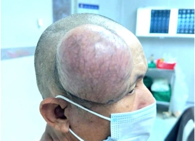 Phẫu thuật thành công khối u to như cái chén ở đầu bệnh nhân ảnh 1
