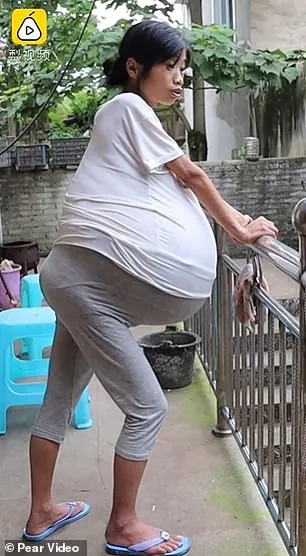 Người phụ nữ gây sốc vì bụng phình khổng lồ suốt 2 năm không rõ nguyên nhân ảnh 3