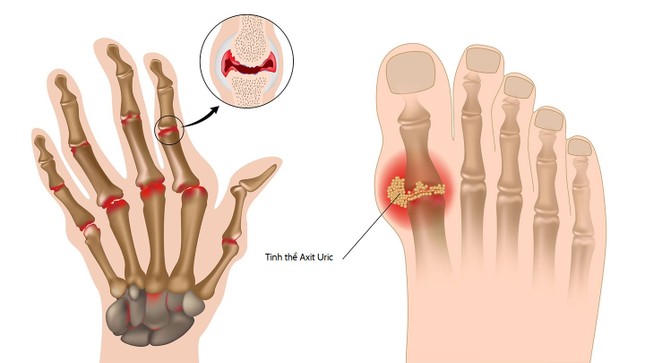 Chuyên gia khuyên dùng nước ion kiềm và thực phẩm có tính kiềm cho bệnh gout ảnh 2