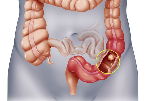 Chuyên gia khuyến cáo cách phòng tránh bệnh ung thư top 5 ảnh 1