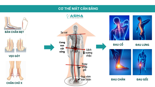 Lót giày chỉnh hình 3D ASINA, “ bước đột phá” trong điều trị bàn chân bẹt và cân bằng cấu trúc cơ thể ảnh 1