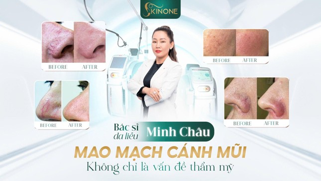 SkinOne - Đột phá trong điều trị mao mạch cánh mũi và da thâm đỏ ảnh 1