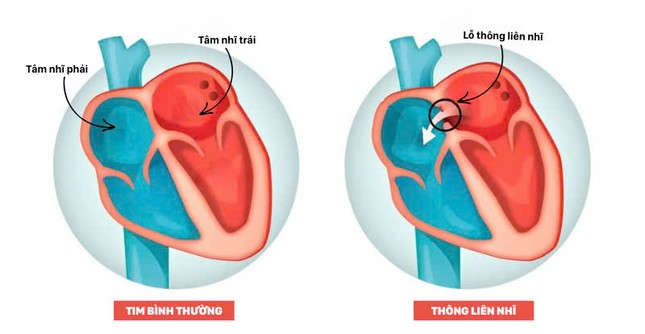 'Bít dù' vá lỗ thủng tim cho bệnh nhân 39 tuổi mới biết mắc dị tật tim bẩm sinh ảnh 1