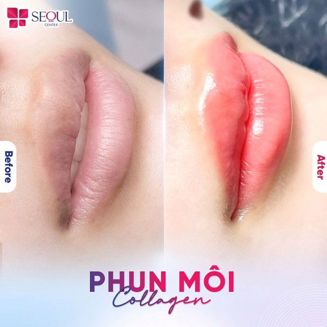 Khám phá địa chỉ phun môi công nghệ cao uy tín ảnh 1