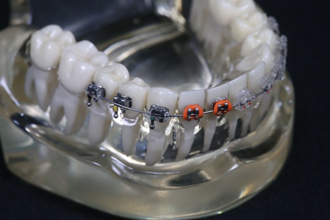 Bảng giá niềng răng chỉnh nha tại Nha Khoa Đăng Lưu ảnh 1