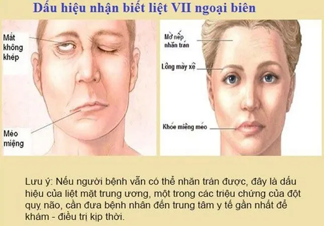 Phòng khám Lão Nhà Quê - Ứng dụng YHCT trong điều trị liệt dây thần kinh số VII ảnh 1
