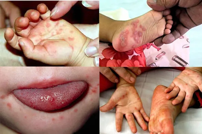 Bệnh tay chân miệng ở trẻ và cách chăm sóc an toàn từ Nước lá bàng Lão Nhà Quê ảnh 1