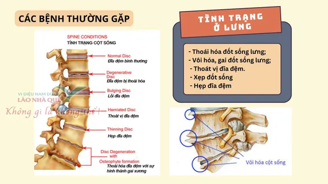 Phương pháp 'Khai thông cột sống' hỗ trợ điều trị đau do thoái hóa khớp tại Lão Nhà Quê ảnh 1