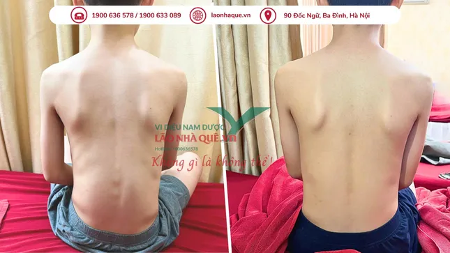Phương pháp 'Khai thông cột sống' hỗ trợ điều trị đau do thoái hóa khớp tại Lão Nhà Quê ảnh 3
