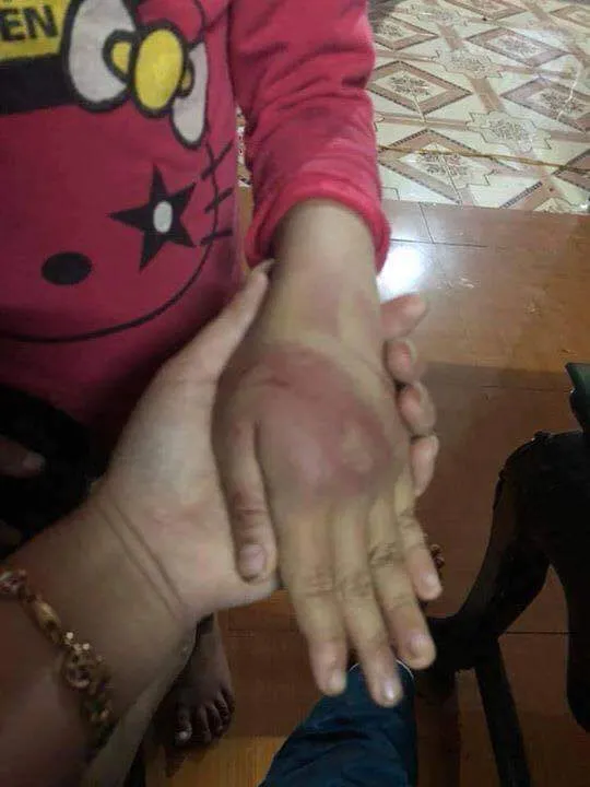 Công an vào cuộc vụ bé lớp 2 bị bố đánh thâm tím ảnh 1