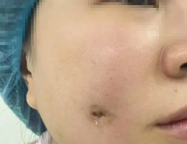 Người phụ nữ bị nhiễm trùng sau khi làm má lúm đồng tiền ảnh 1