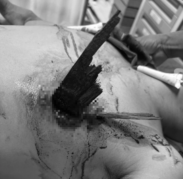 Chạy xe máy mất lái đâm vào hàng rào, nam thanh niên bị thanh gỗ đâm thấu ngực ảnh 1