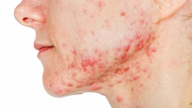 Sắp có vắc xin ngừa mụn trứng cá ảnh 1